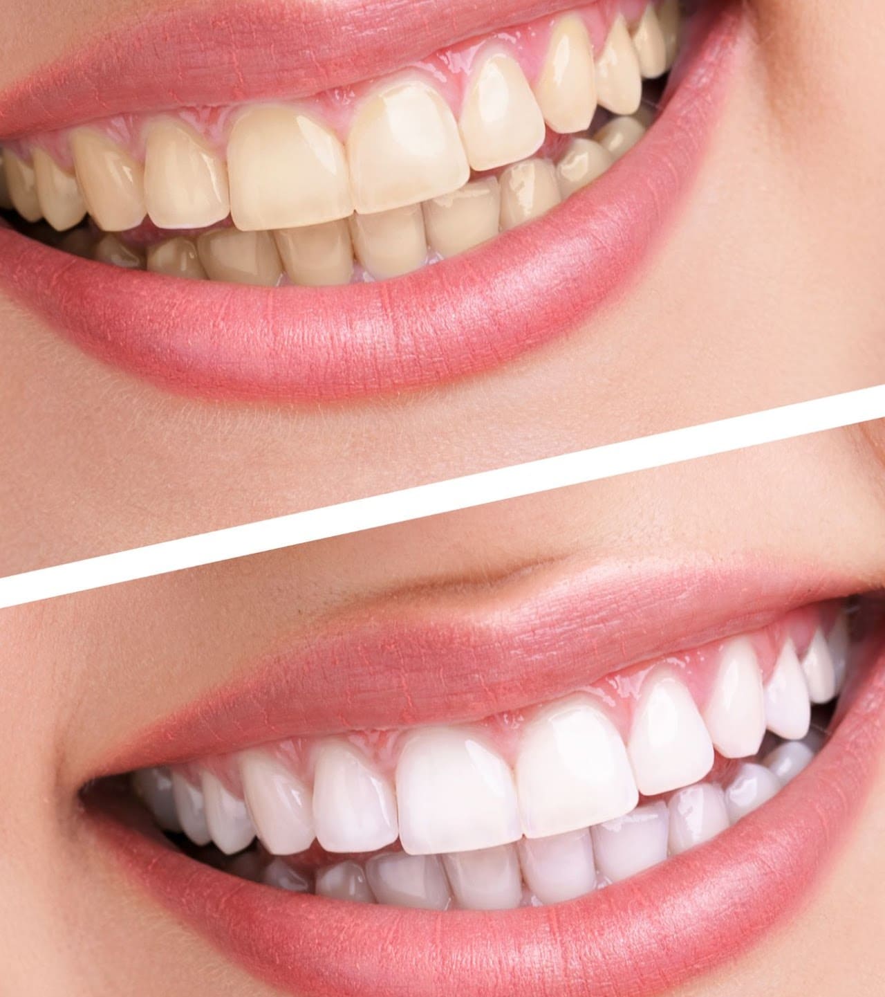 Вініри Луцьк — естетична стоматологія Філігранно